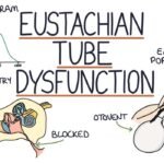 Eustachian Tube Dysfunction