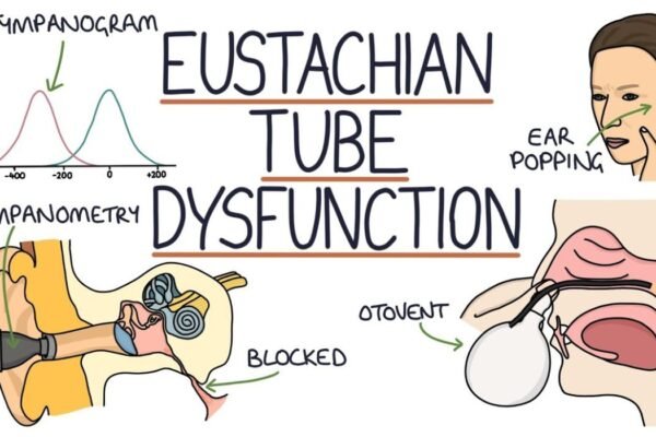 Eustachian Tube Dysfunction