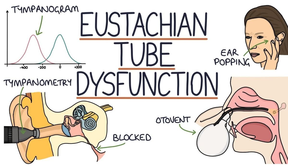 Eustachian Tube Dysfunction